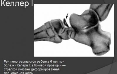Болезнь Келлера – остеохондроз (в России — остеохондропатия), поражающий предплюсневую ладьевидную кость. Она наблюдается…