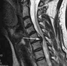 Синдромы спинальной компрессии В грудном отделе позвоночника несомненно имеются анатомические условия для сдавления спинного…