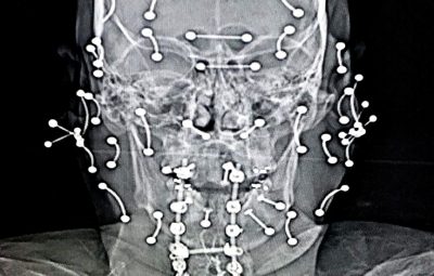 Рентген пациента с пирсингом: