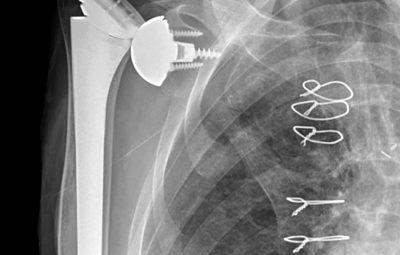 На рентгеновском снимке довольно частая травма – вывих протеза плечевого сустава: