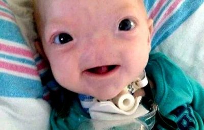 Мальчик родился без носа. Это последствие редкого генетического заболевания — аплазии костей носа