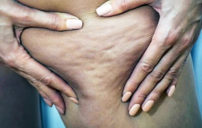 ЛИПОДИСТРОФИЯ И ЦЕЛЛЮЛИТ Липодистрофия (жировая дистрофия) — патологическое расстройство образования жировой ткани. Встречается два…