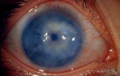 Глаукома — заболевание глаз, характеризующееся повышением внутриглазного давления в результате нарушения оттока водянистой влаги