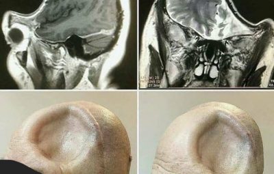 Отсутствие костей черепа после удаления обширной опухоли головного мозга: