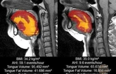 На МРТ снимках хорошо видно то, как жир (желтый цвет на снимке) может помешать…