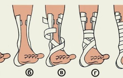 Основы тейпирования голеностопа Внимание! Это НЕ кинезиотейпирование. Это жёсткое тейпирование специальными спортивными жёсткими тейпами….