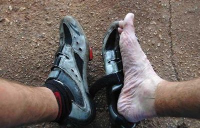 Траншейная стопа: как сырая обувь доводит до ампутации Траншейная (окопная) стопа — разновидность отморожения,…