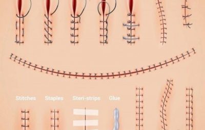 Виды хирургических швов