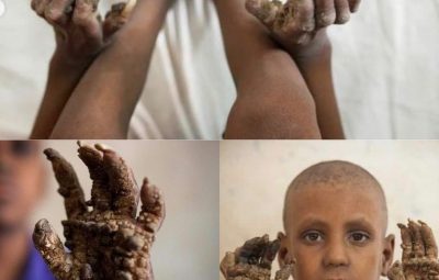 Тело семилетнего Саркера Рипона из Бангладеш покрыто чешуйчатыми бородавками. Его конечности как будто обрастают…