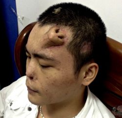 Китайские доктора вырастили пациенту новый нос прямо у него на лбу. Его собственный нос…