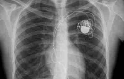 Кардиостимулятор на рентгене:
