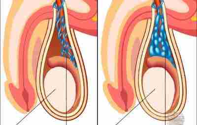 Варикоцеле — это варикозное изменение вен семенного канатика, сопровождающееся нарушением венозного оттока от яичка….