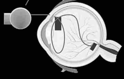 Электронное протезирование зрения (ретинальный бионический чип) Отрывок из книги нейробиолога Дэвида…