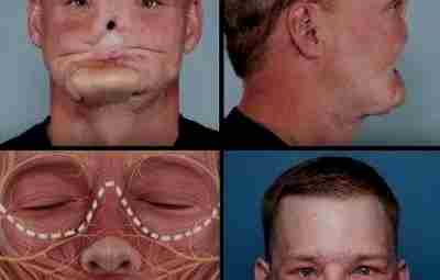 Хирурги проделали сложнейшую трансплантацию лица: