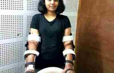 Житeльница Индии, которой пересадили мужские руки Конечности пришлось ампутировать по локоть после страшного ДТП,…