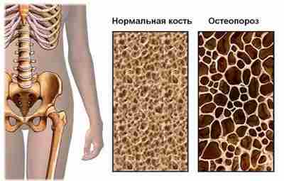 МАССАЖ ПРИ ОСТЕОПОРОЗЕ Постепенное снижение минеральной плотности костей, потеря массы скелета и истончение его…