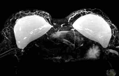 Силиконовые имплантаты в груди на аппарате МРТ: