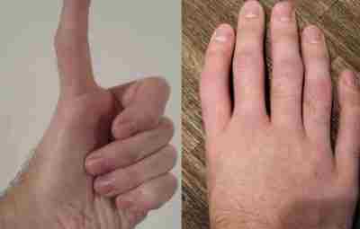 Обычно у людей все пальцы кроме первого (большой палец) имеют три фаланги, а большой…