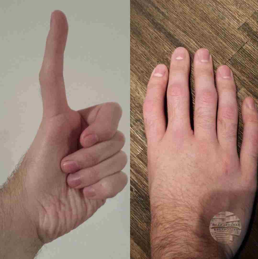 Трехфаланговый большой палец