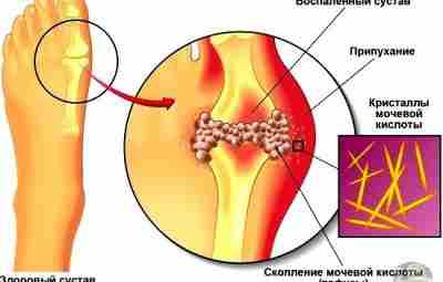 Тофусы — это особые узелковые образования, которые могут возникать у людей, страдающих подагрой. Подагра…