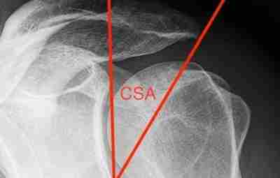 Критический угол плеча (Critical shoulder angle-CSA ) Является расчетным рентгенологическим признаком, который, по результатам…