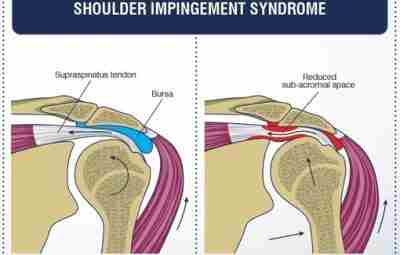 Синдром сдавления вращательной манжеты плеча. Частой проблемой, с которой люди сегодня обращаются к неврологам,…