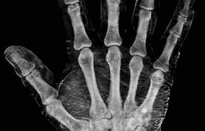 Рентгеновский снимок руки, смоченной в йоде: