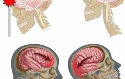 Сотрясение головного мозга — легкая закрытая черепно-мозговая травма, обусловленная сотрясением мозга внутри черепной коробки…