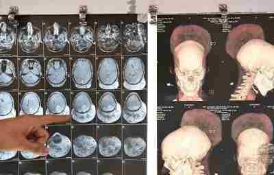 Пациент, 31 год. Опухоль очень больших размеров. Опухоль выступала из черепа мужчины. Сразу несколько…