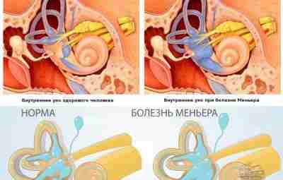 Болезнь Меньера — заболевание внутреннего уха невоспалительного характера, проявляющееся повторяющимися приступами лабиринтного головокружения, шумом…
