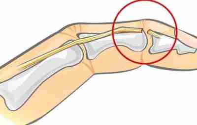 Молоткообразный палец и палец регбиста Молоткообразный палец — это сгибательная деформация дистального межфалангового сустава…