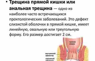 ТРЕЩИНА ЗАДНЕГО ПРОХОДА Несколько цветков календулы залить в кружке кипятком (треть кружки). Закрыть крышкой…