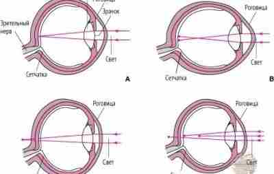Наглядно виды аномалий органа зрения. (A) Эмметропия; (B) миопия; (C) гиперметропия; (D) астигматизм