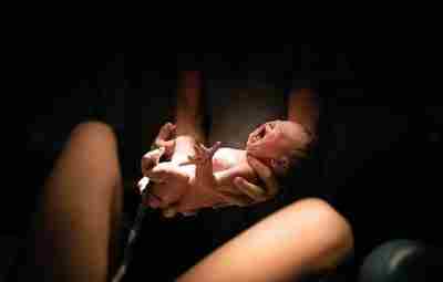 Отсроченное перерезание пуповины повышает выживаемость недоношенных детей Когда ребенок рождается преждевременно, врачи часто перерезают…