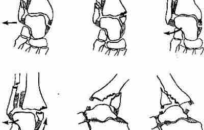 Переломы области голеностопного сустава и лодыжек Переломы области голеностопного сустава относятся к наиболее часто…