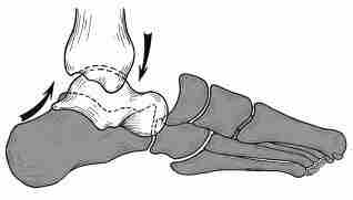 Подтаранные вывихи стопы Вывихи в подтаранном суставе, составляющие около 1 % от всех травматических…