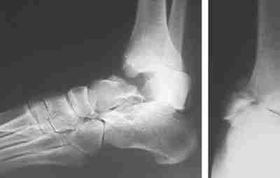 Переломовывихи таранной кости Такие переломовывихи встречаются редко. Тяжесть повреждения определяется наличием сложного и трудновправляемого…