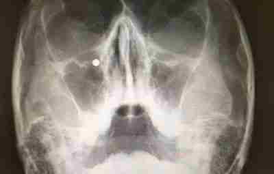 Рентгенограмма, подтверждающая наличие инородного тела гайморовой пазухи