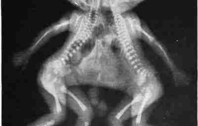 Рентгеновский снимок сиамских близнецов