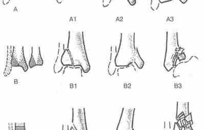 Переломы пилона большеберцовой кости Термин «пилон» (пестик) введен французским рентгенологом Десто в 1911 г….
