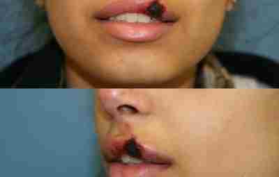 Клинический случай частичного некроза левой части верхней губы после инъекции гиалуроновой кислоты