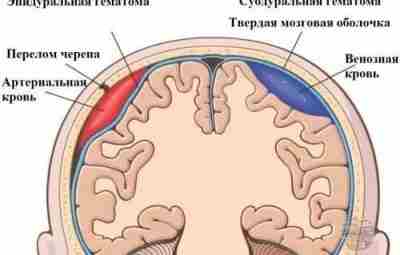 Эпидуральная гематома Располагаются между твердой мозговой оболочкой и костью. Клиника: периоды ⃣светлый промежуток: в…