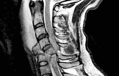 Травма спинного мозга в результате перелома позвоночника. Результат ДТП: