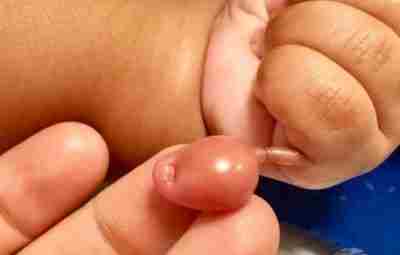 2-летний малыш с необычным случаем полидактилии. Напомню, что это врождённая аномалия, связанная с наличием…