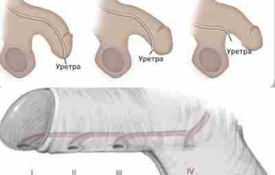 Гипоспадия — порок развития мочеполовой системы, при котором наружное отверстие уретры располагается не на…