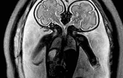 МРТ-снимок сиамских близнецов в утробе матери: