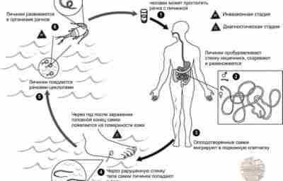 Дракункулез (известный как болезнь ришты) — калечащая паразитарная болезнь, вызываемая Dracunculus medinensis, длинным нитевидным…