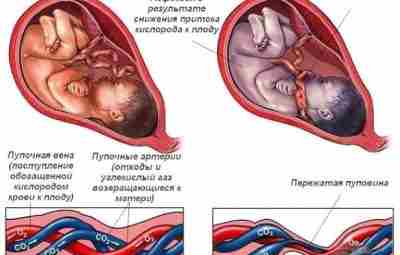 Обвитие пуповиной встречается у 25-30% беременных женщин. Суть его заключается в том, что вокруг…