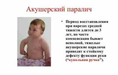 Акушерские параличи руки у детей («родовые плечевые плекситы») Акушерский паралич — повреждение плечевого сплетения…