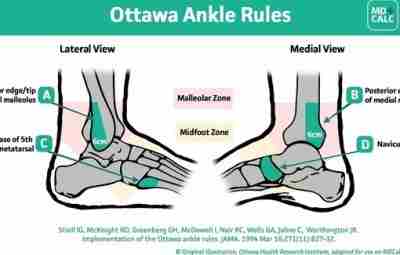 Ottawa Ankle Rules Оттавские правила голеностопа определяют необходимость выполнения рентгенограмм при острых травмах сустава….